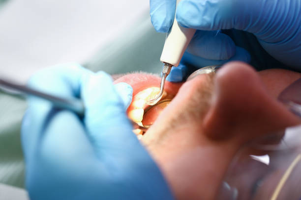 Best Dental Abscess Treatment in Homestead, FL